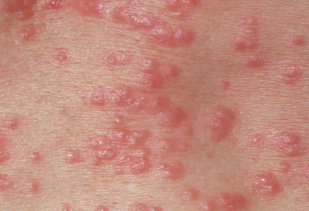 Which Skin Cream Takes Care of Rashes and Bug Bites?